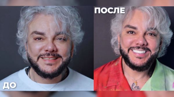 Киркоров продолжает «перекраивать» внешность. Опубликованы кадры певца с новыми зубами